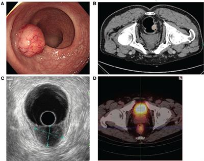 Case report: Indocyanine green fluorescence-guided imaging in laparoscope, a more sensitive detection technique of lateral lymph nodes metastases from rectal neuroendocrine tumors